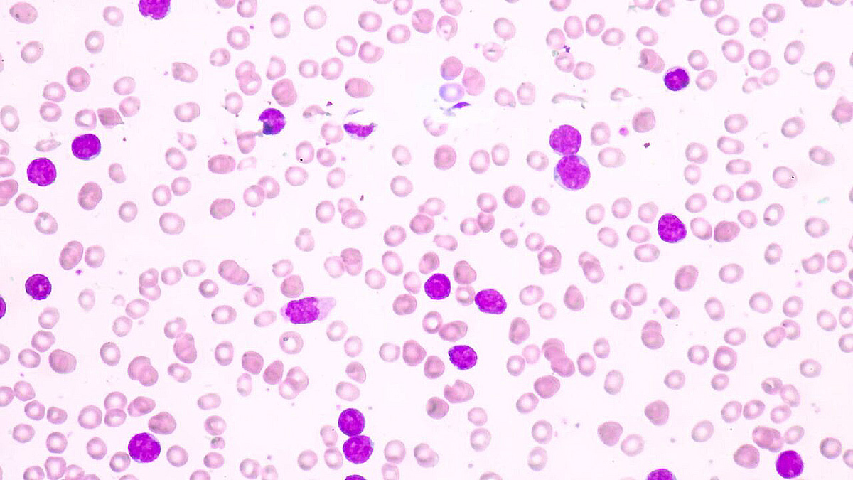 featured image for USC researchers find genetic variant contributing to disparities in childhood leukemia risk