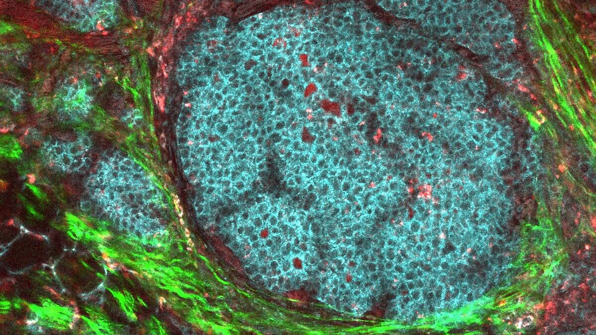 featured image for Turning a tumor’s ‘shield’ into a weapon against itself