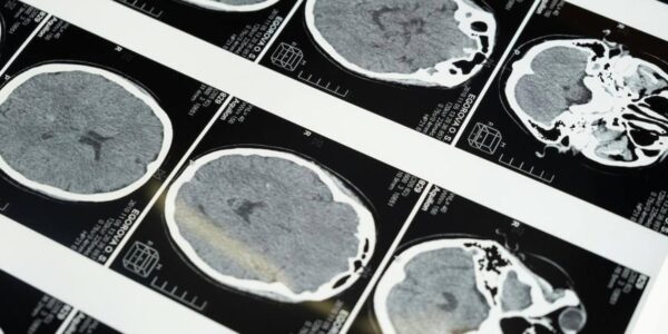 featured image for How AI might help in diagnosing mild concussions