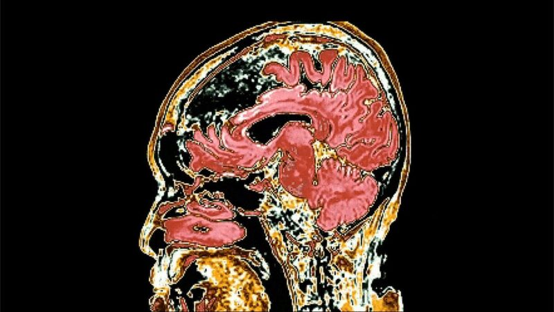 featured image for From blood tests to brain scans: How AI is revolutionizing Alzheimer’s research